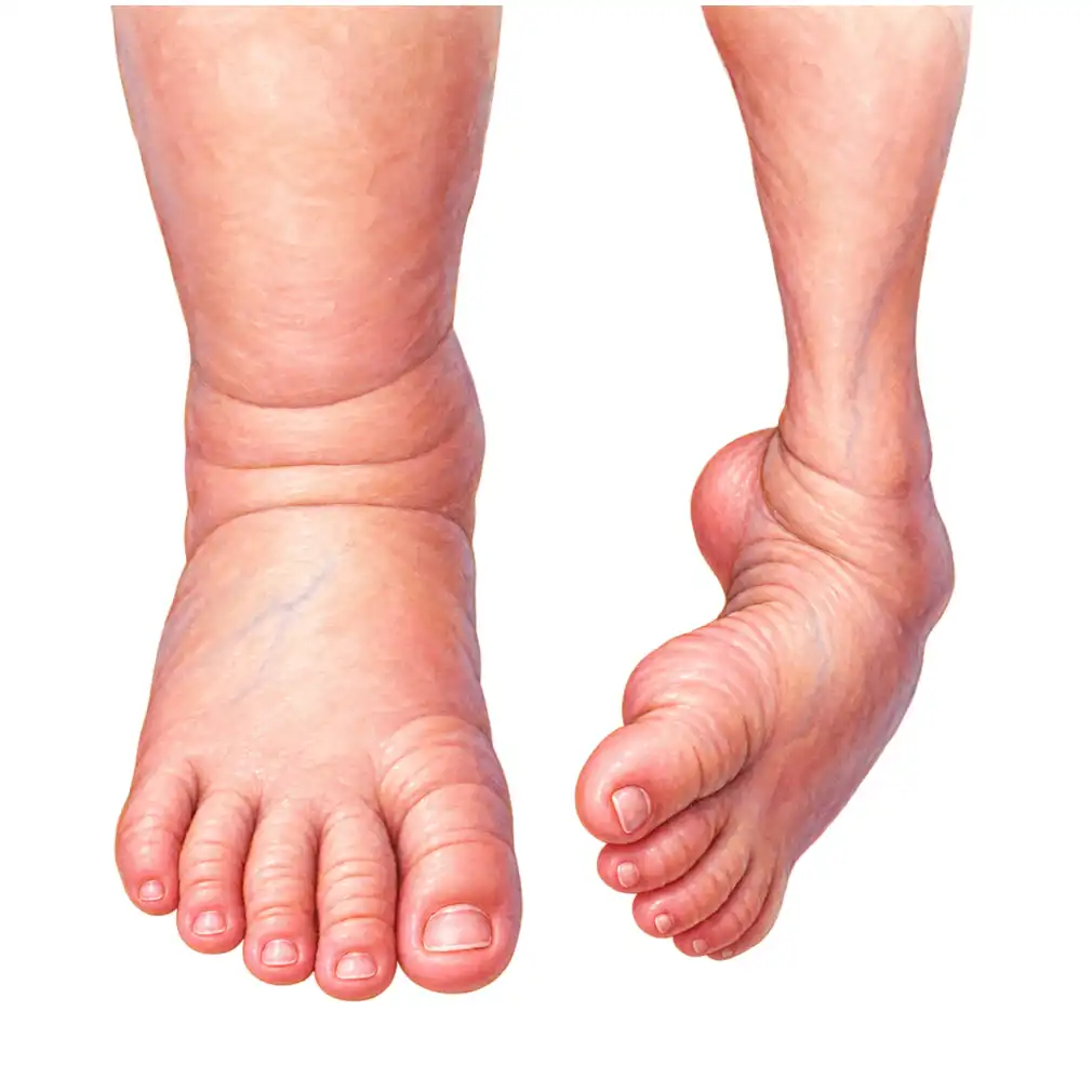 The sole faces inward or upward and cannot be straightened by hand. The baby is in no pain.