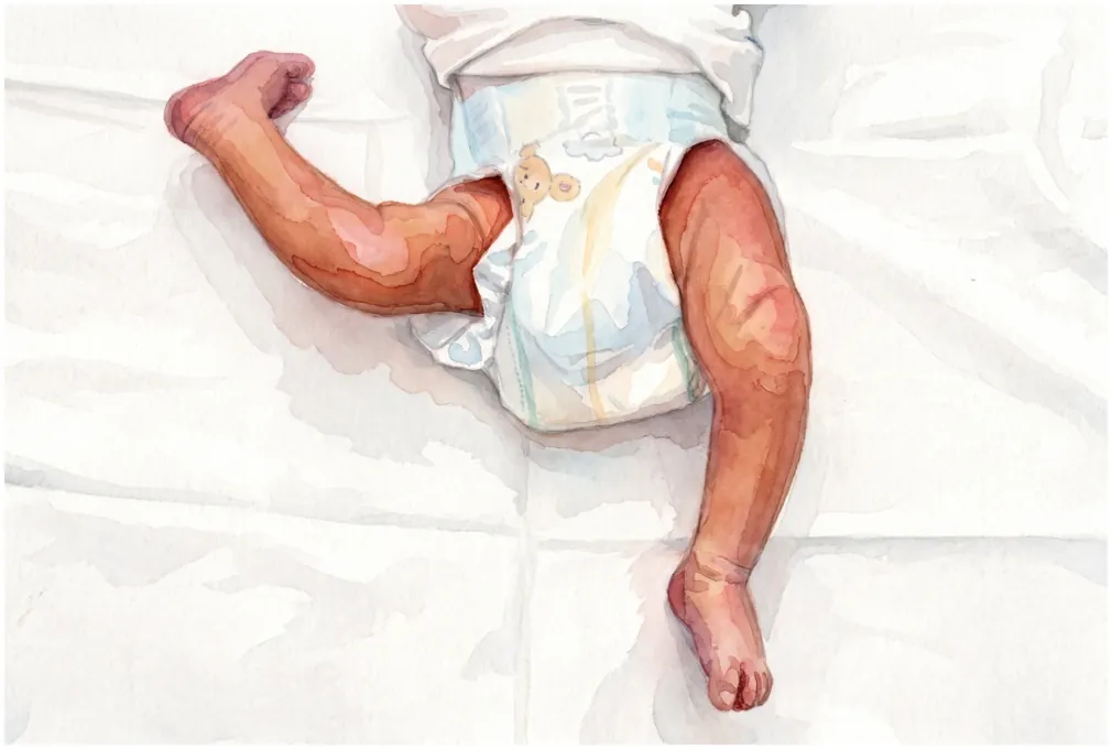 In congenital knee dislocation the baby's knee bends backwards at birth.