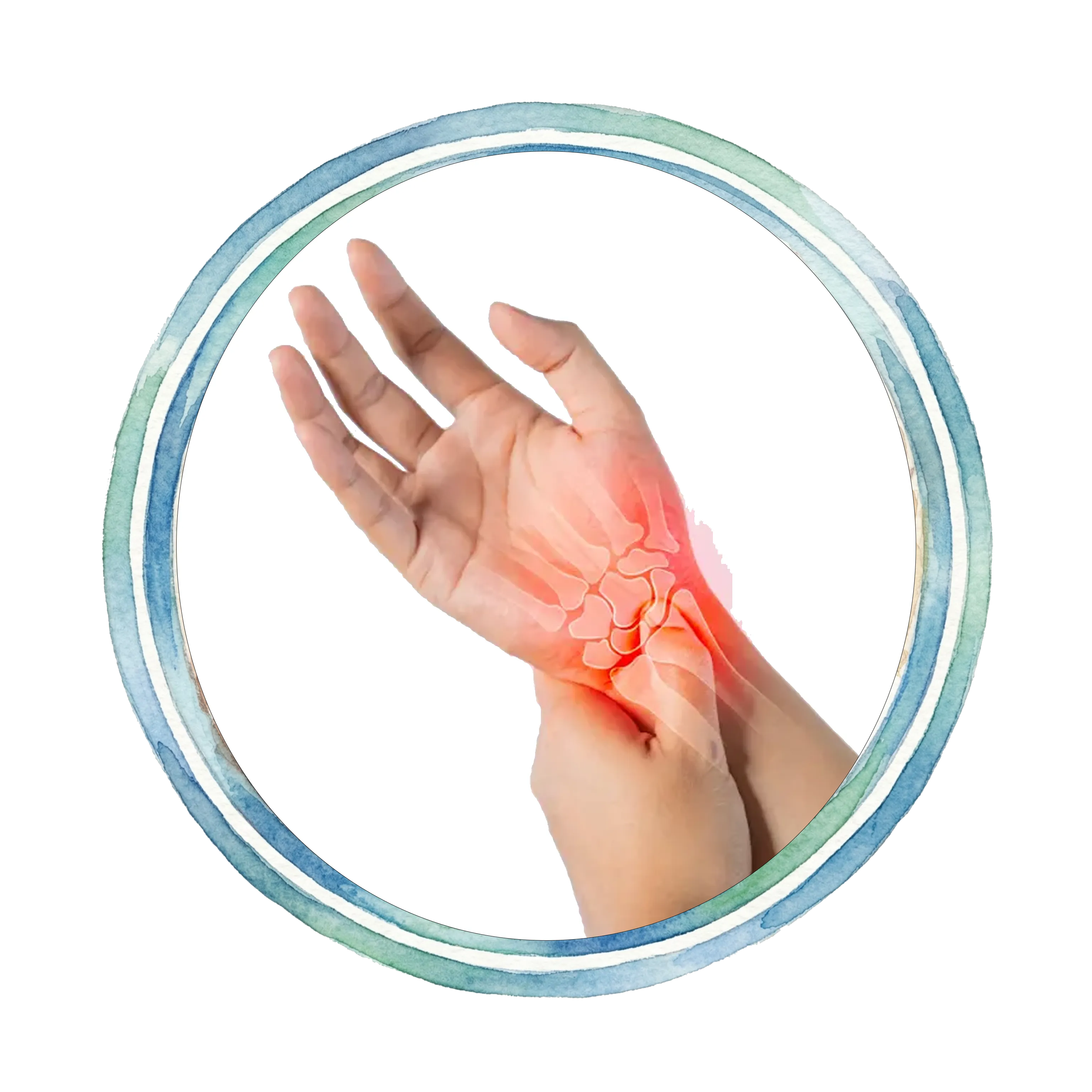 Carpal Tunnel Syndrome