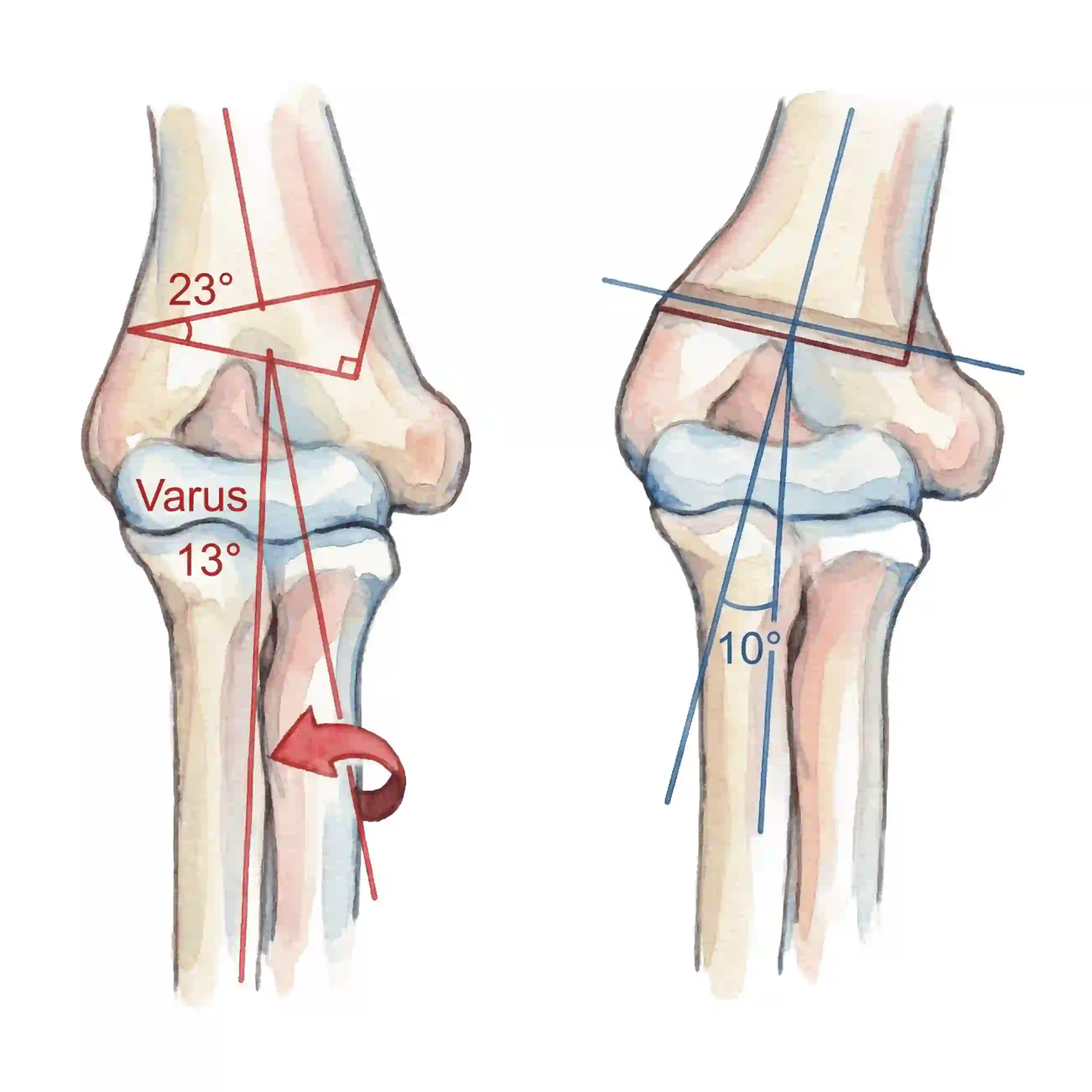 What is Cubitus Varus?