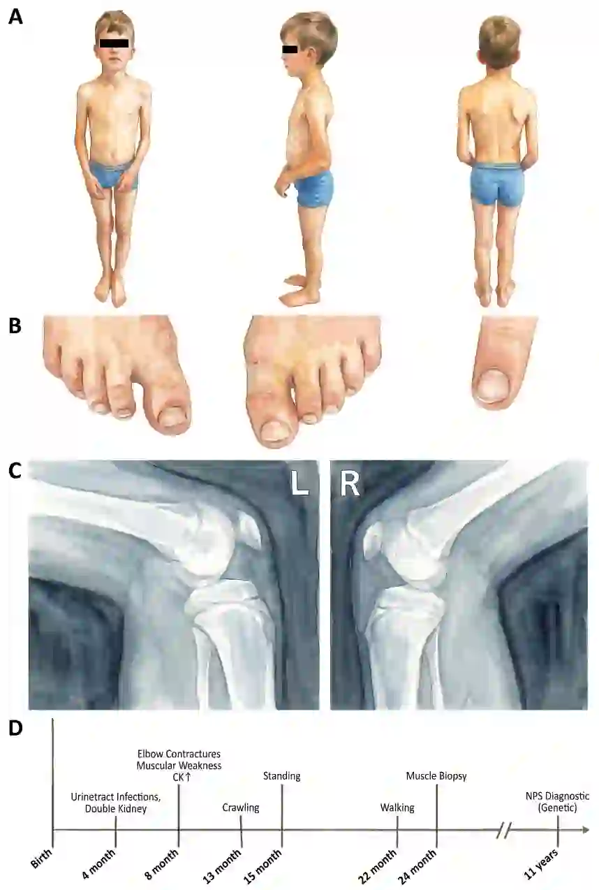 A child with nail patella syndrome - stance, the nail and toe changes, knee X-rays showing the small patella, and the timeline to diagnosis