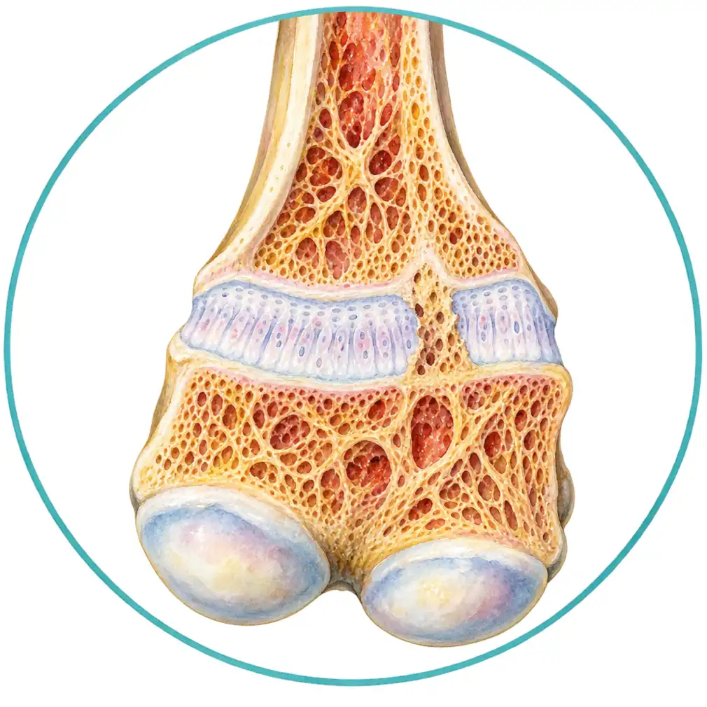 A child’s bone grows from a soft band of cartilage near each end. After an injury part of that band can be replaced by a bridge of solid bone — a physeal bar.