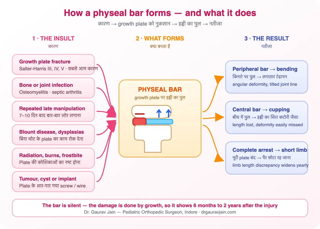 Physeal bar causes and consequences chart - growth plate fracture, infection, Blount disease and radiation leading to peripheral, central or complete growth arrest