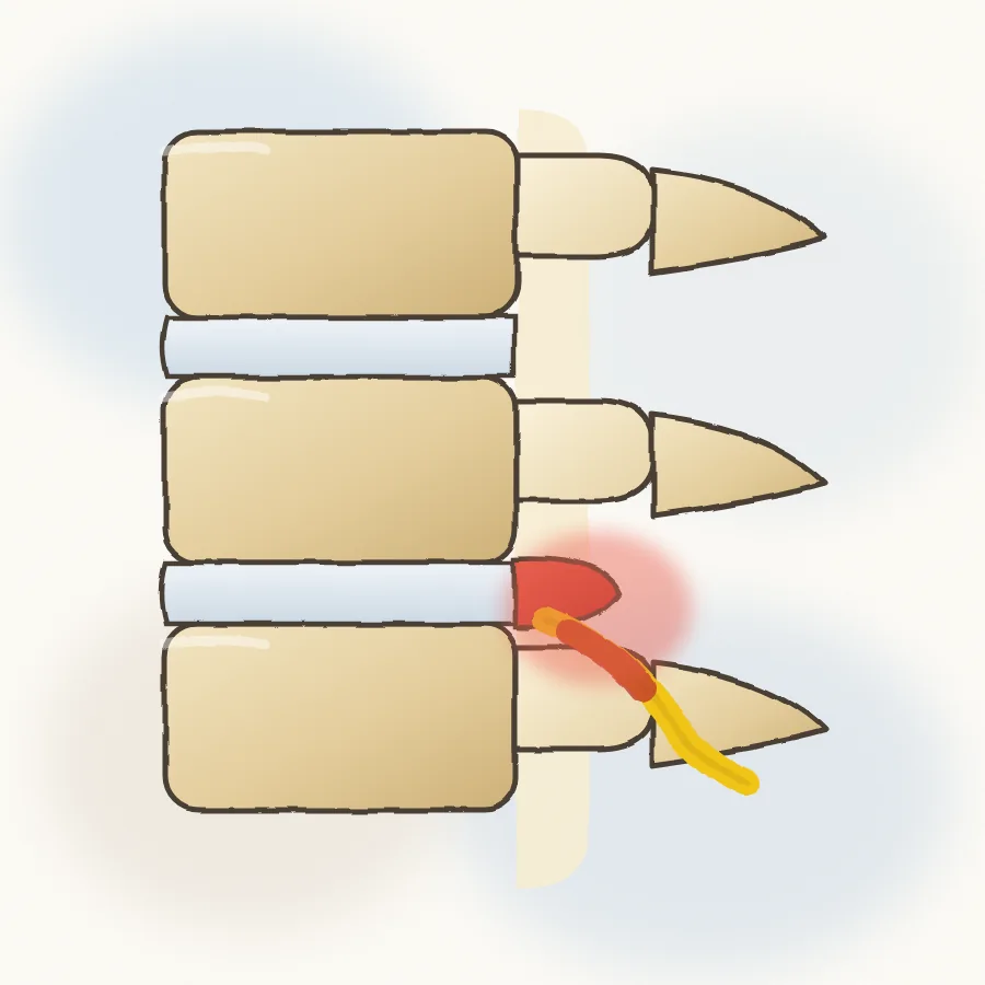 Lumbar spine in side view with a herniated disc pressing on a nerve root